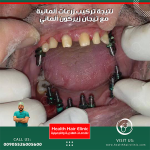 نتيجة زراعة الاسنان