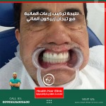 نتيجة زراعة الاسنان