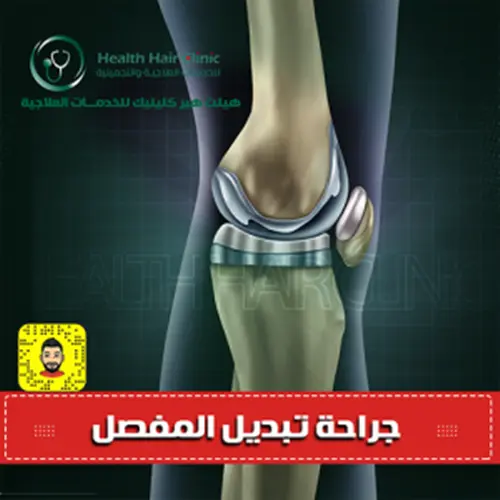 استبدال مفصل الركبة