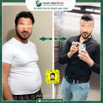 تكميم المعدة في تركيا