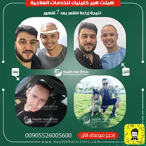 نتائج عملية زراعة الشعر في تركيا نتائج عملية زراعة الشعر في تركيا